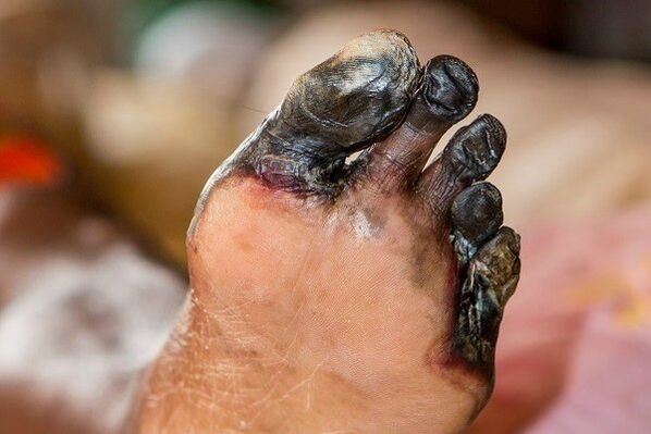 Pieds doigts gangrène sur diat